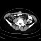 Umbilical metastasis, Sister Mary Joseph syndrome: CT - Computed tomography